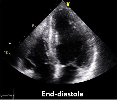 Min Gyu Kang, et al. Stress cardiomyopathy after pacemaker C D Figure 2.