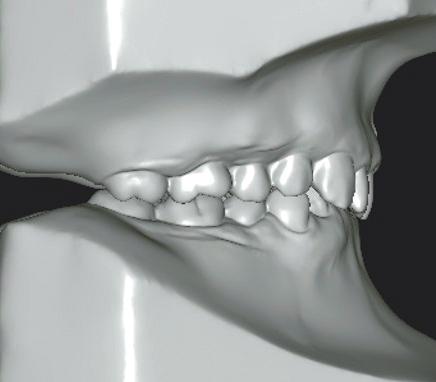 A Case of Treatment Using Bialveolar Anterior Segment Osteotomy of an Adult Patient with Deep Bite Lee
