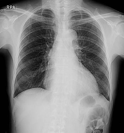 - 김도형외 4 인 : 혈액투석환자의발생한자발성종격동출혈 - Figure 1. Normal findings on chest PA four months before admission. Figure 2. At admission, chest PA shows mediastinal widening.