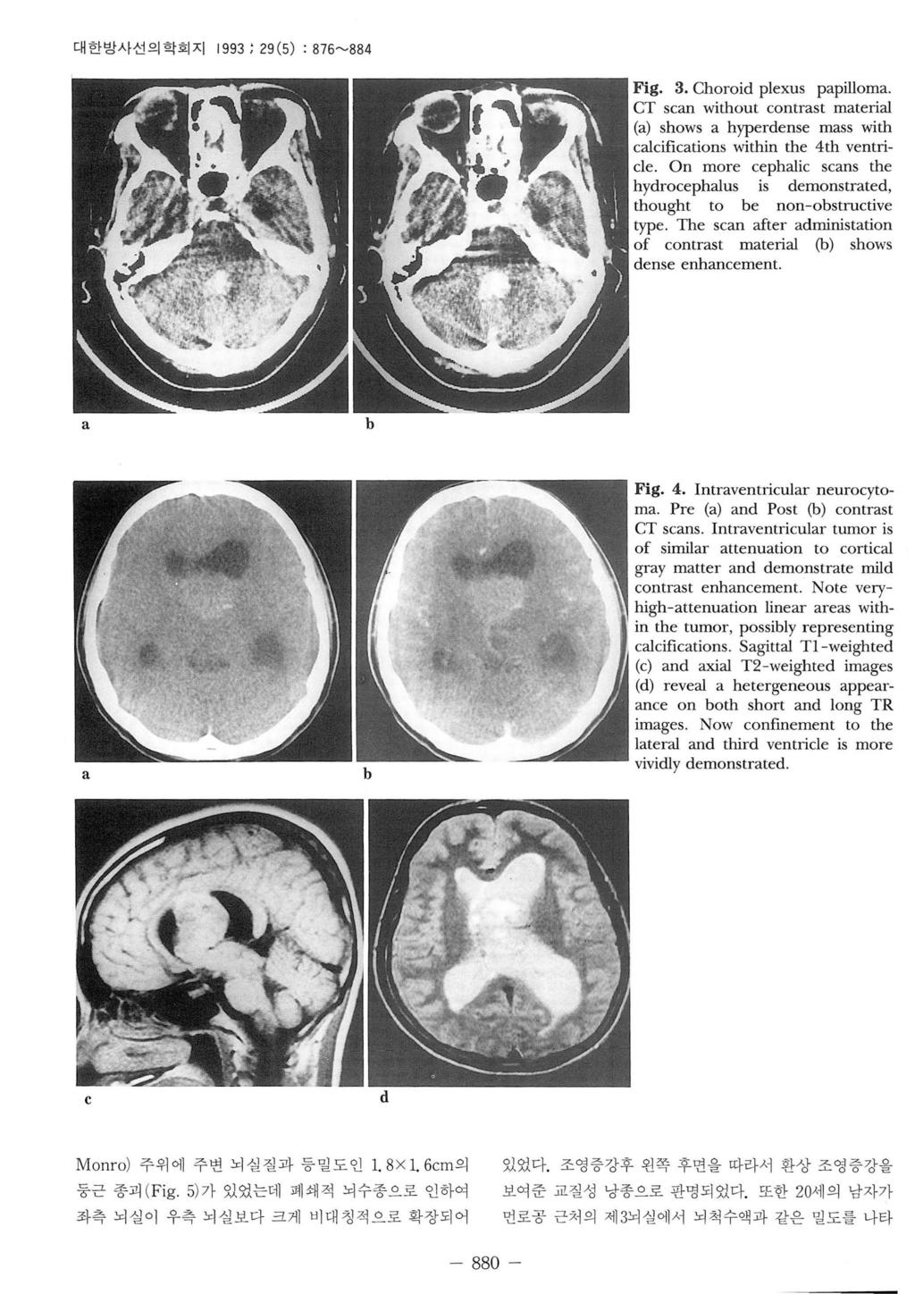 대한방사선의학회지 99 ; 9 (5) : 876~88 Fig.. Choroid plexus ppillom. CT scn without contrst mteril () shows hyperdense mss with clcifictions within the th ventricle.