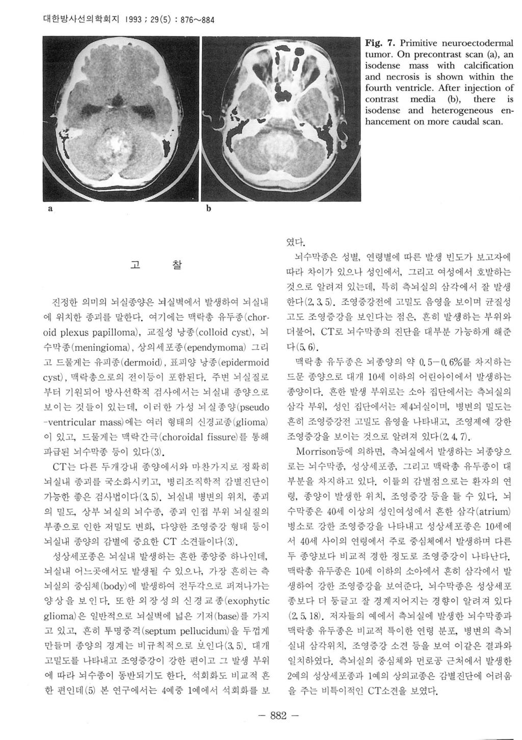 대한방사선의학회지 99 ; 9 (5) : 876~88 Fig. 7. Primitive neuroectoderml tumor. On precontrst scn (), n isodense mss with clcifiction nd necrosis is shown within the fourth ventricle.