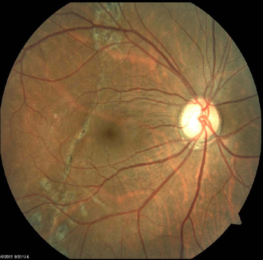 - 강현승 외 : 침술에 의한 안구천공과 시야장애 - A B C Figure 2. Postoperative examination. (A) Fundus photograph reveals improved distortions after the operation and yet remained retinal tear.