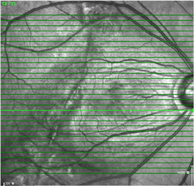 (C) Spectralis Domain Optical Coherence Tomography (SD-OCT) reveals persistent retinal nerve fiber disconnection with the epiretinal membrane removed.