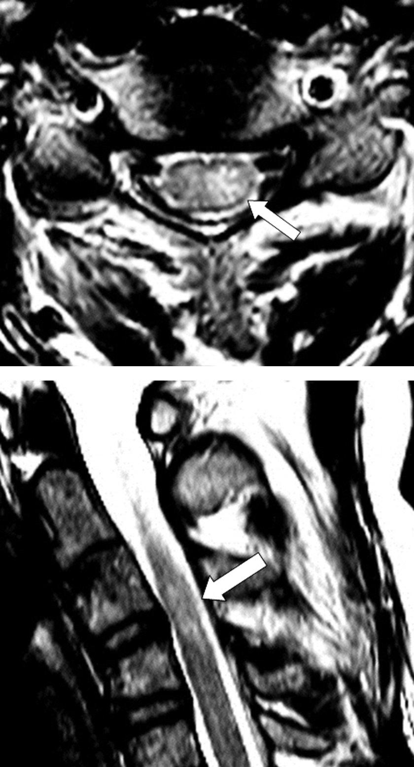 Seung-Pyo Suh et al Volume 24 Number 4 December 31 2017 A B Fig. 3. Computed tomography of the cervical spine.