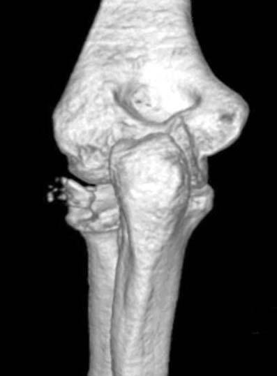 요골두골절의예후인자 601 2. 골절의분류및동반손상주관절탈구는 20예, 몬테지아골절과동반된요골두골절은 4예그리고 1예는 Essex-Lopresti 병변을보였다.