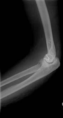 602 강호정ㆍ문은수ㆍ박진오외 3 인 Fig. 2. (A) Pre-operative radiological finding of Mason type III radial head fractures and capitulum fracture involving an elbow joint dislocation.