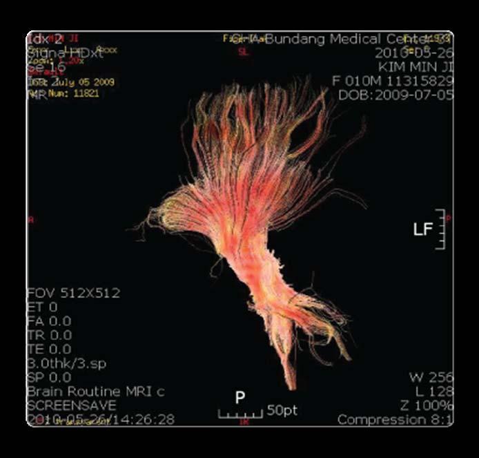 Changes in fiber tractography
