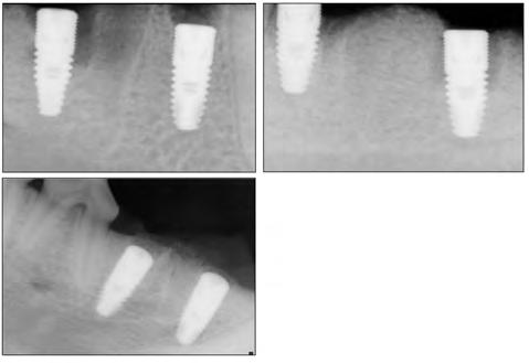 Choi YJ, et al: Comparison of the bone formation after immediate implant placement 57 2. 방사선관찰 1) 식립시관찰식립당시에는다근치에서 mesial 쪽으로 microthread에인접하여 gap이다수관찰되었으며, gap은 bone material로채워졌다.