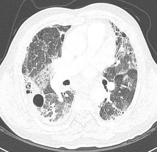 DJ Kim et al. Acute Exacerbation of Idiopathic Interstitial Fibrosis: CT Prognostic Factors (A) Fig. 2.