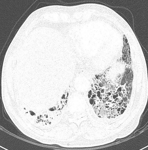 Axial CT images show patch distributed ground glass attenuation in the mid-level of both lungs in the back ground of severe interstitial
