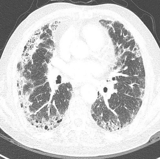 CT images of acute exacerbation of IPF with peripheral ground glass pattern.