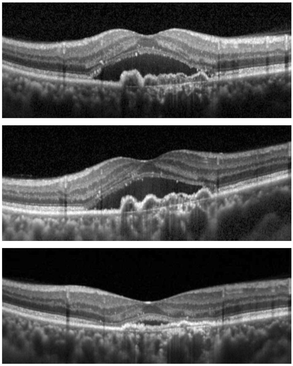 - 대한안과학회지 2017 년제 58 권제 1 호 - A B C Figure 3. A representative case of neovascular age-related macular degeneration.