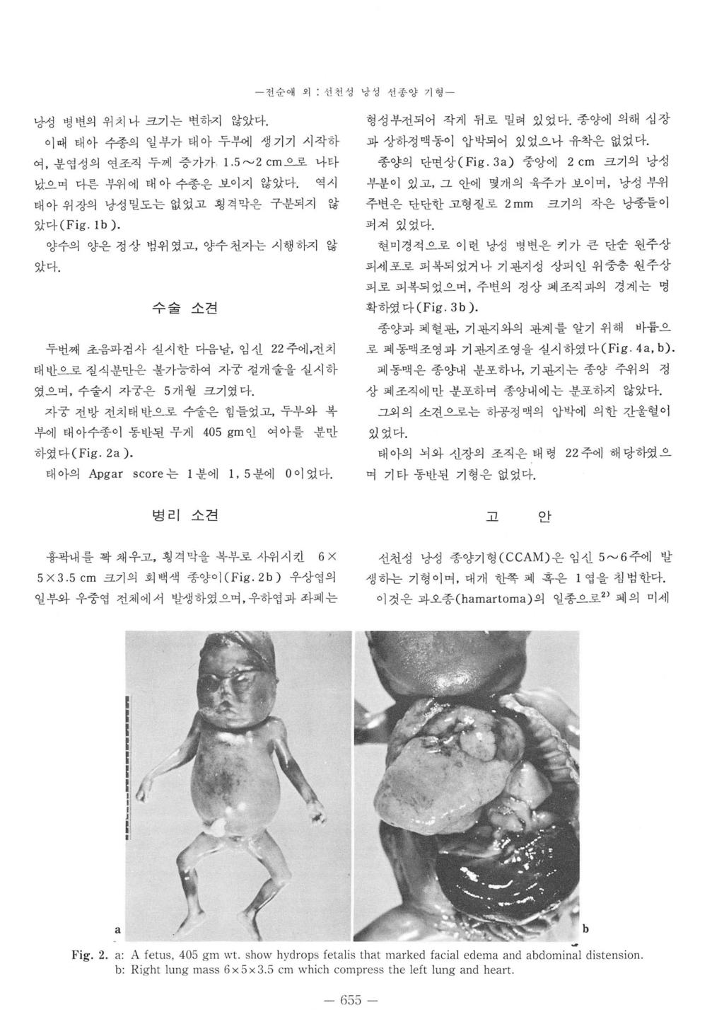 - 선순애외선천성냥싱선종양기행 - 낭성영변의위치냐크기는변하지 않았다. 이예태아수종의일부가태아두부에생기기시작하 여, 분엽성의연조직누께증가가 1.5~2 cm_ 으로나타 났으며다흔부위에태아수종운보이지않았다. 역시 태아위장의낭성밀도는없었고횡격막은쿠분되지 않 았다 (Fig. lb). 양수의양은정상범위였고, 양수천자는시행하지않 았다.