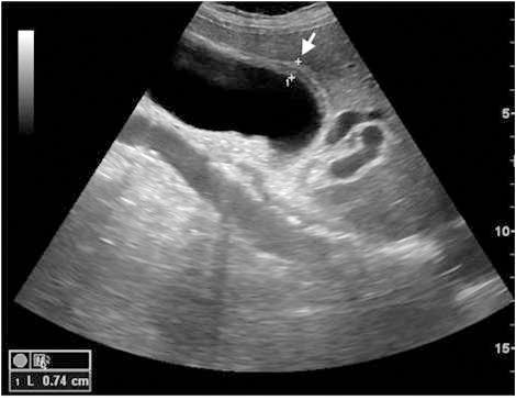 - Jin Woo Choo, et al. Toxocariasis induced acute cholecystitis with pericarditis - 개회충증은현재까지국내문헌에눈과폐를침범한증례가 [3] 드물게보고되었지만담낭과심낭을동시에침범한경우는보고된적이없다.