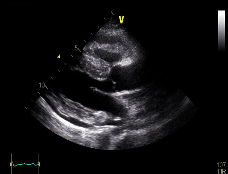- 대한내과학회지 : 제 84 권제 6 호통권제 634 호 2013 - A B Figure 3. Echocardiography shows moderate effusion at the left ventricular apex (max = 15 mm). (A) Parasternal long-axis diastolic view.