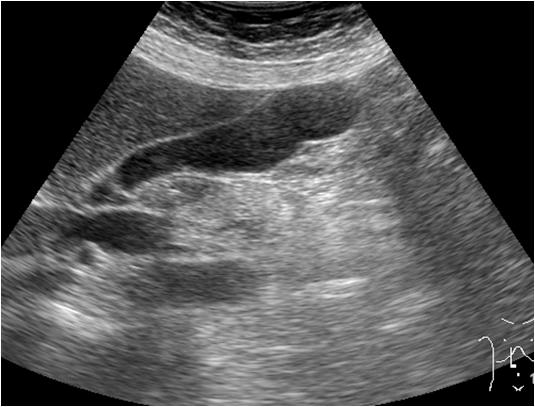 - 추진우외 6 인. 개회충증에의한담낭염, 심장막염 - Figure 5. Abdominal ultrasonography after 2 months shows improvement in the thickening of the gallbladder wall. 호전된소견을보였으며, 2개월후시행한추적복부초음파검사에서담낭염의소견또한호전되었다 (Fig. 5).