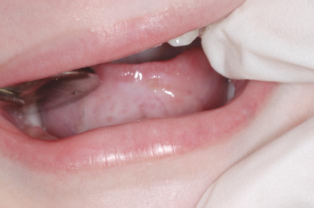 Korean Association for Disability and Oral Health 8(1) 2012 Fig. 5. Three-week follow-up after tongue protector delivery. Fig. 6. Three-month follow-up. Fig. 7. Six-month follow-up. Ⅲ.