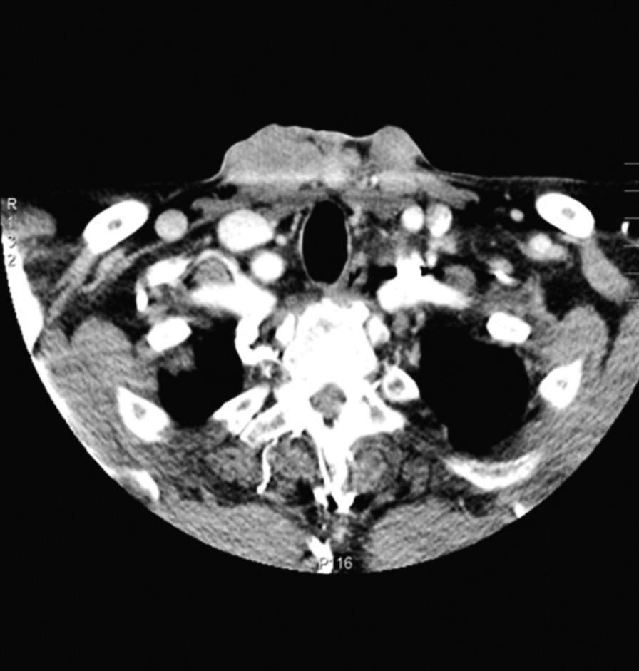 Pharynx CT shows 5.