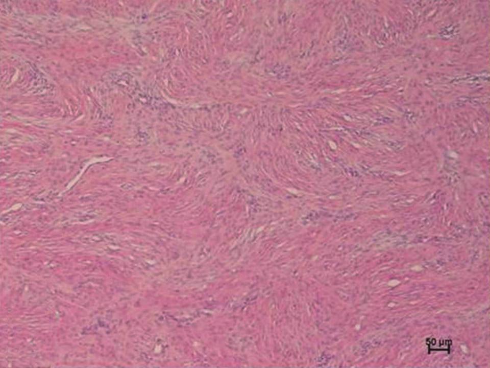 4) 증상은 주위 피부 의 모세혈관확장증이 동반된 분홍색의 판(plaque)형태로 시 작하여 결절(nodule)의 형태로 성장한다.