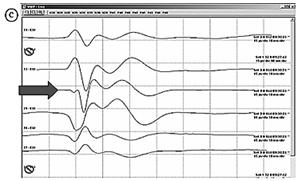 Illustrated intraoperative SEP recording on the sulcus. 한다. 왼쪽에서눈금두칸위치화살표에해당하는파형을자세히보면파형이약하게아래로내려갔다가올라왔다가다시내려간다 (Fig.
