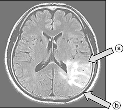 15를보면뇌종양이전두엽 (frontal lobe) 과두정엽 (parietal lobe) 사이부분이아니라상당히측두엽 (temporal lobe) 과후두엽 (occipital lobe) 부분으로치우쳐있다.