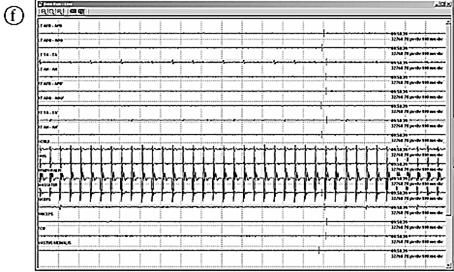 Bipolar stimulator