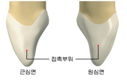 3) 근심면 1 순측연과설측연의최대풍융부위 치경 1/3 부위 2 상악중절치에비해치경선만곡이더약함 3 접촉부 - 절단 1/3부위와중앙 1/3부위의경계에위치