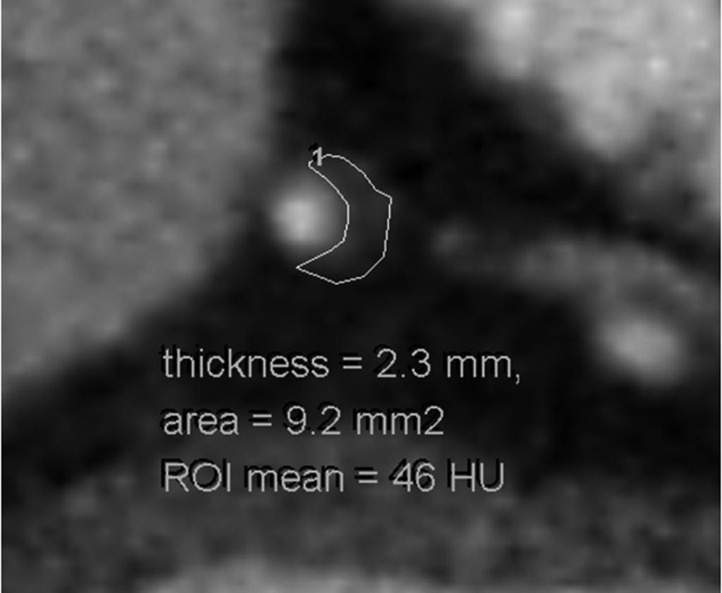 stenosis (arrows) in proximal left anterior