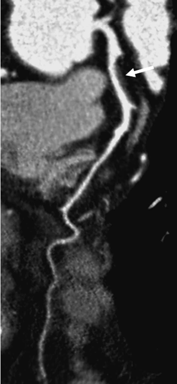 Shortaxial reformatted image (C) of the lesion