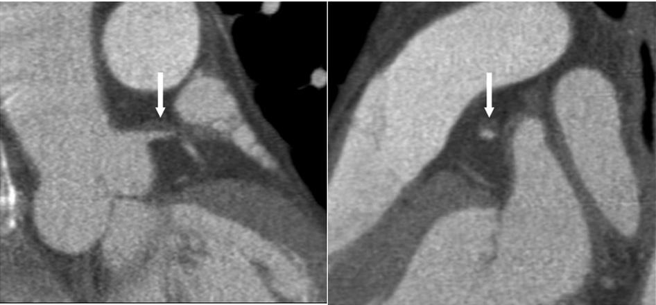 Choe YH A B Figure 3. 48yearold male with acute myocardial infarction.