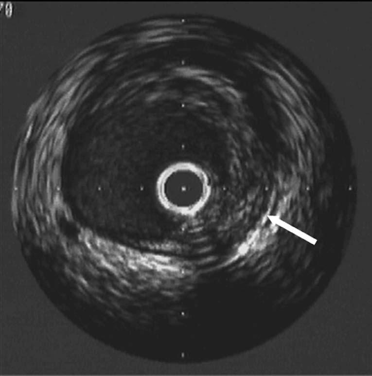 main coronary artery.