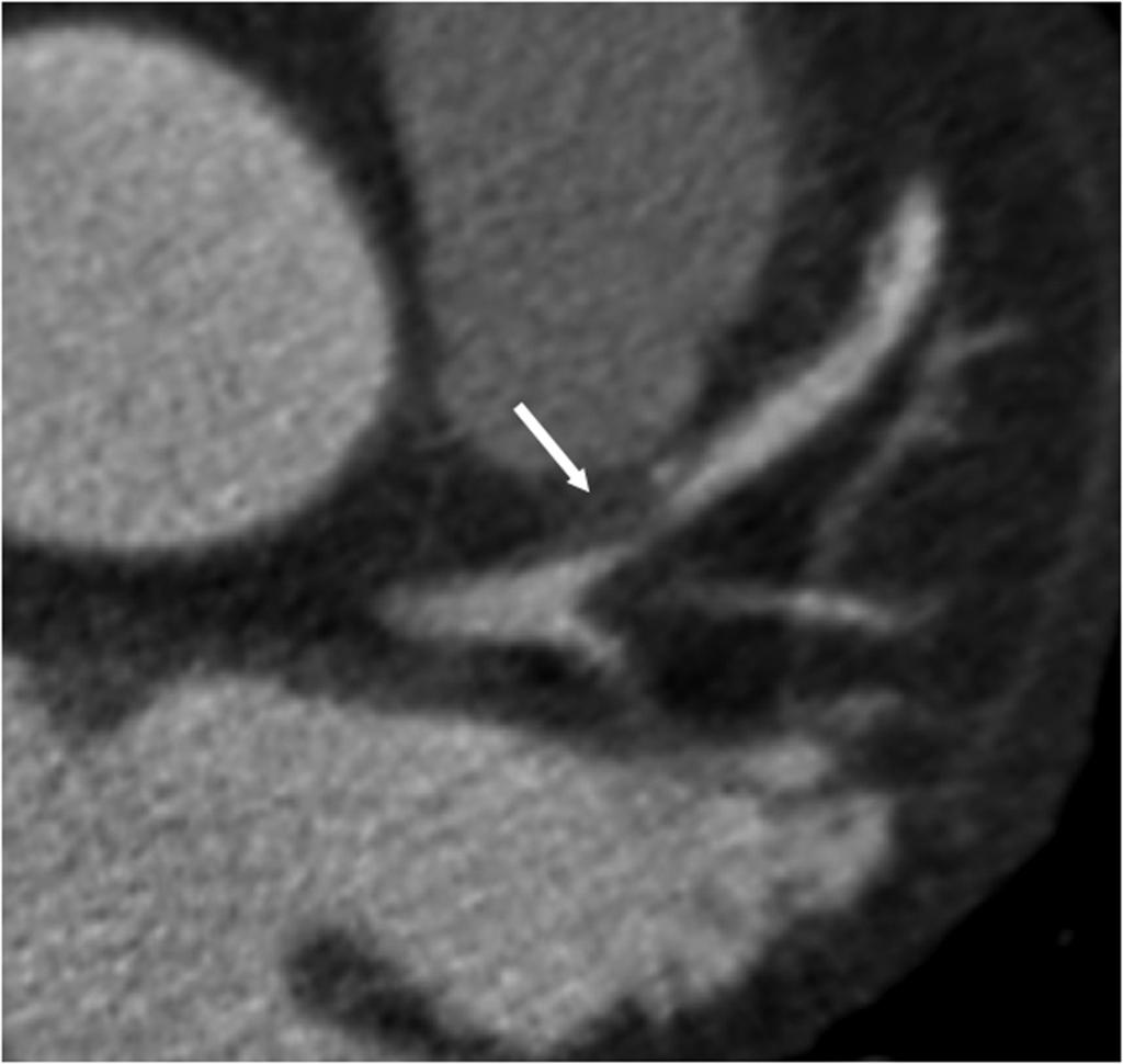 Volumerendered (A) and axial reformatted (B) images show