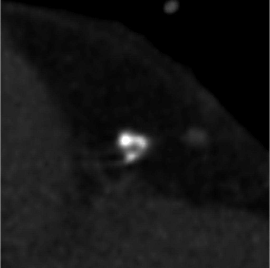 calcifications (arrows) in mid left anterior descending branch adjacent to the origin