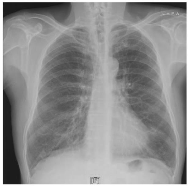7 단원. 증례 4. 흉부엑스선 CT 5. 판정 : COPD, emphysema dominant 6. 해석 : 진단단계에서아래의해석표에따라구분한다 Yes FEV 1 /FVC>70% (0.