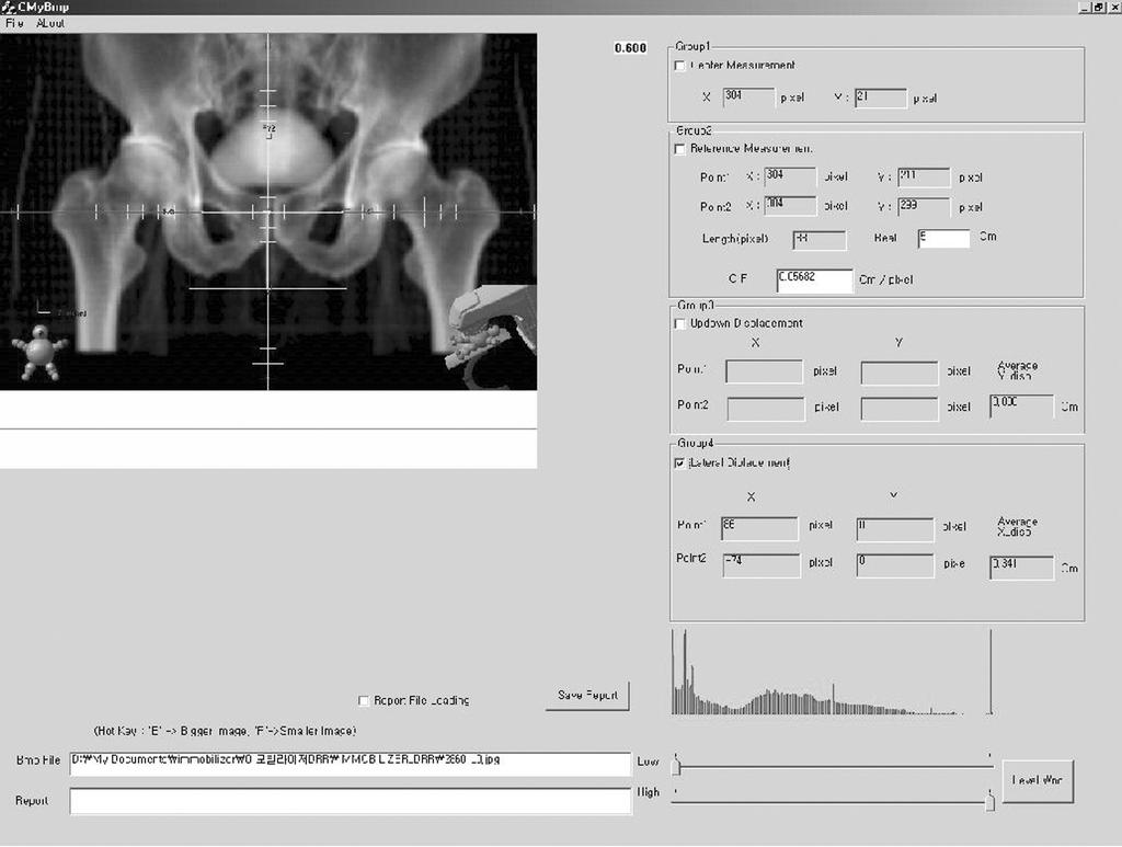 The cranio setup error was measured on an anterior- image. The reference point was determined 3cm distant from isocenter in the X axis.
