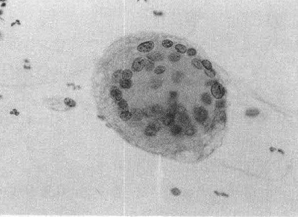 Colloido phages on cytic degeneration smear(pap, 400 x )