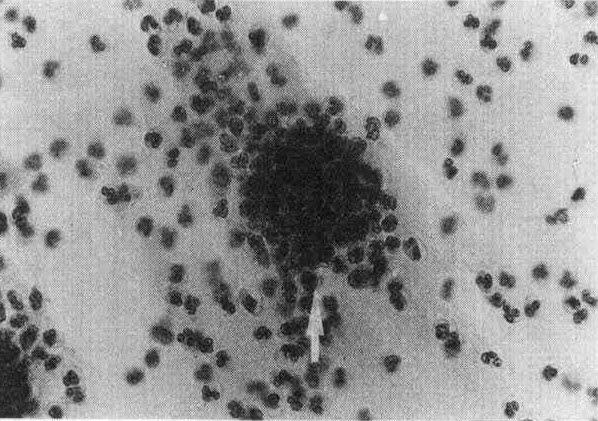 Marginal vacuole on Graves' disease smear(pap, 400 x ).