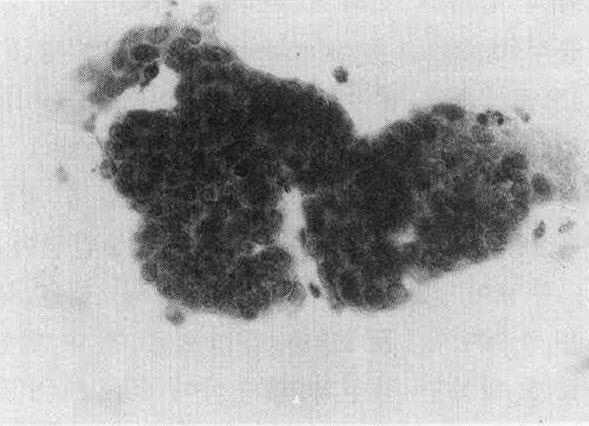 carcinoma smear (H & E, 400 x ) Fig. 10.