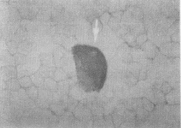 smear(pap, 1000 x) Fig. 11.