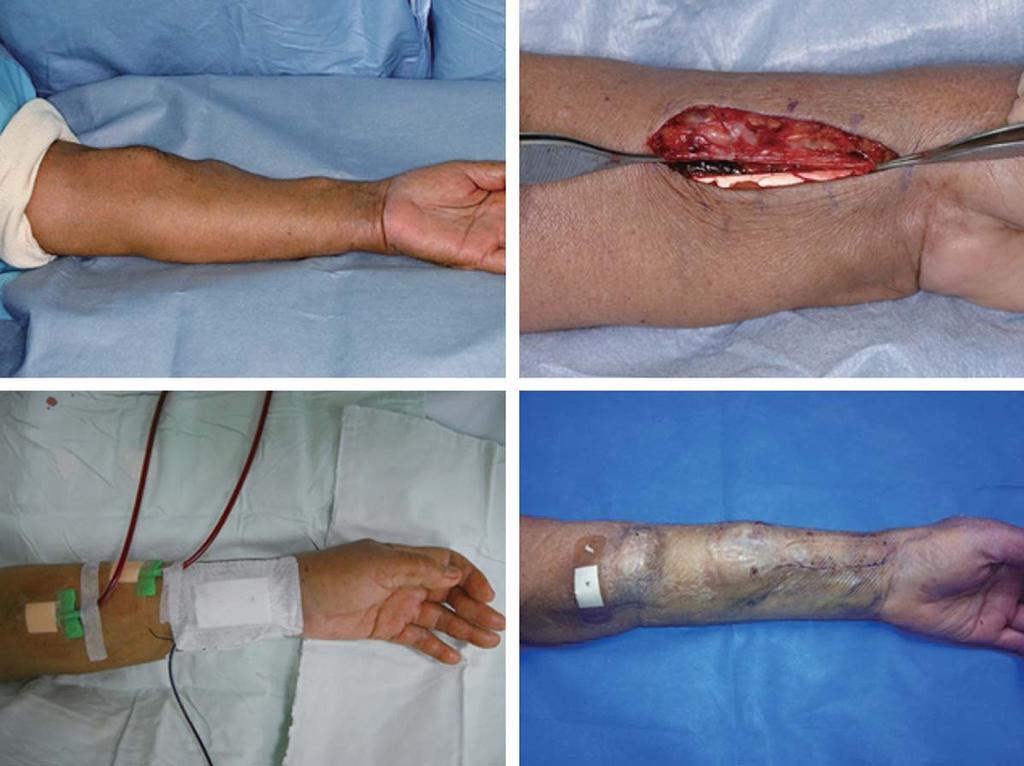 J Korean Soc Surg Hand Vol. 20, No. 3, September 2015 Fig. 1. (A) The upper arm which have distal radius fracture with ipsilateral arteriovenous fistula is on hand table.