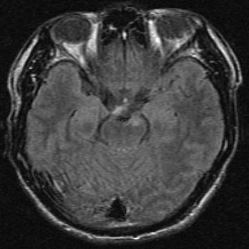 장지혜외 A B C D E F Fig. 2. A 33-year-old man with neurosyphilis involving the left oculomotor nerve. A. FLAIR axial image shows ill-defined high signal intensity at left anterior midbrain.