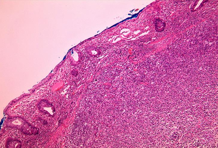 (D) Immunohistochemical stains reveal that neoplastic