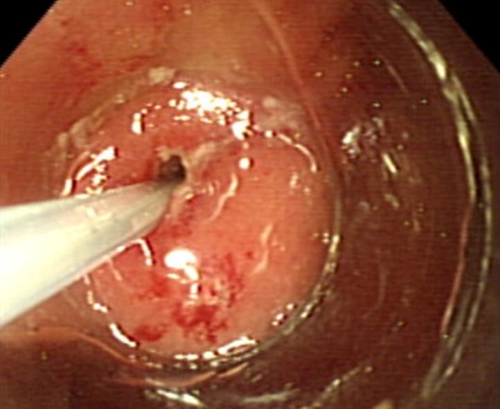 64 전남의대학술지 제46권 제1호 2010 Fig. 2. Fistulotomy in a Billroth II patient.