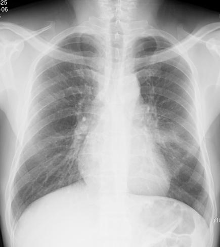 Tuberculosis and Respiratory Diseases Vol. 61. No.4, Oct. 2006 Figure 2. Chest Computed tomography(ct) shows 5 cm sized Left hilar mass invading pericardium with lymphadenopathy. Figure 1.