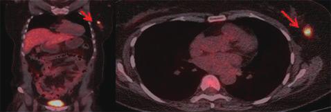 Kim JM, et al. Paraneoplastic Cerebellar Degeneration with Anti-Yo Antibody Fig. 3. Whole body positron emission tomography-computed tomography (PET-CT). Whole body PET-CT scanning shows about 1.