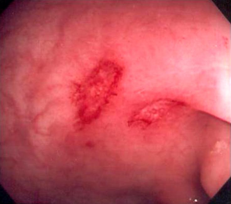 Two aphthous ulcers with erythematous rim are observed at the sigmoid colon.