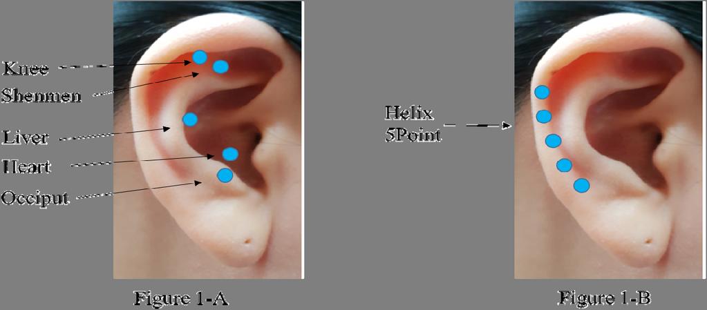 이압요법이 퇴행성 슬관절염 노인의 관절 통증, 관절 가동범위 및 수면에 미치는 효과 Figure 1. Auricular acupressure point for experimental group (1-A), and placebo control group (1-B). 였다. 중재 전 실험군의 VAS는 6.14±2.01, 플라세보 대조군의 6.