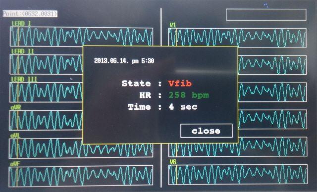 부정맥판단및심박수의변화 (60~258BPM) 도오차없이정확한측정결과를출력하였다. 판별성능을유지한상태에서진행한알고리즘최적화에따른성능평가는실행시간, 단축시간, 성능효율을비교하여분석하였다 [13]. Table1 은심전도의정상상태와부정맥 ( 빈맥, 심실세동 ) 상태의입력신호별임베디드프로그램의최적화전, 후의실행시간을나타낸것이다.