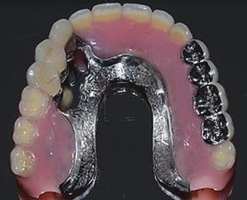 결론 Fig. 11. () Worn artificial teeth, () Metal bite exchange. 본증례는하악대합치가고정성보철물로수복된경우에서상악의치주적으로불리한소수지대치를가지는경우에 hybrid telescopic double crown 으로수복하였다.