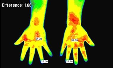 45 ) were compatible with Raynaud s phenomenon (A, C).